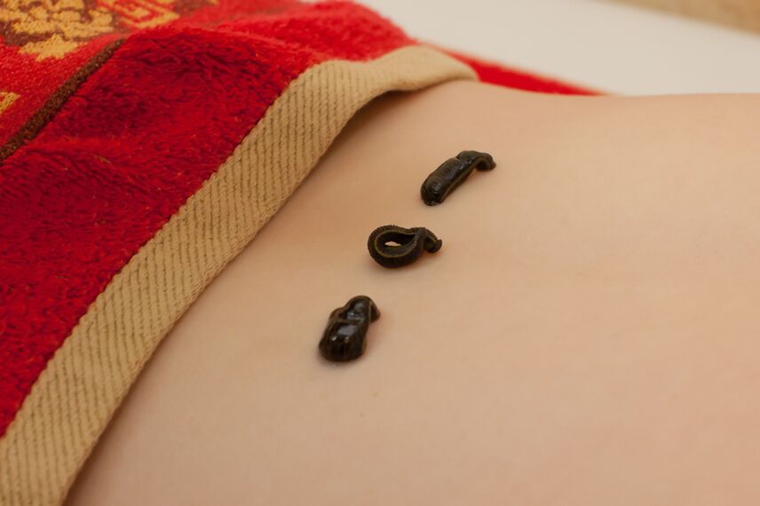 пиявици на долната част на гърба с остеохондроза