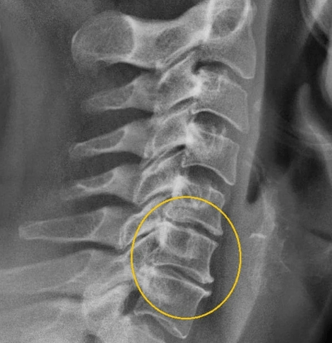 Цервикална остеохондроза